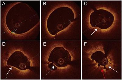 Identification of symptomatic carotid artery plaque: a predictive model combining angiography with optical coherence tomography